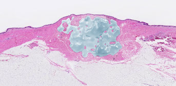 nasha restylane