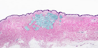 obt restylane